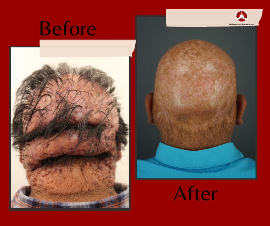 The back of Robert’s head looks so much better after his AKN removal treatments through HPF. *