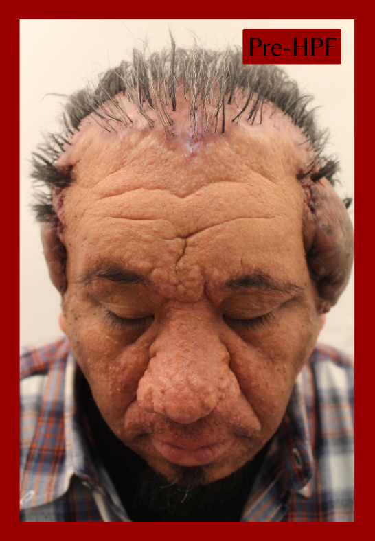 Robert suffered from a severe case of AKN for two decades.